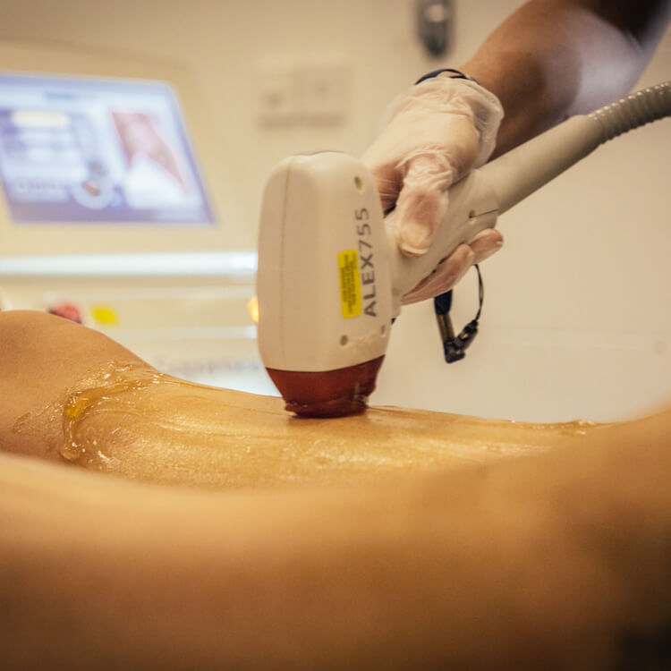 More and more males are opting for our Soprano ICE laser hair removal