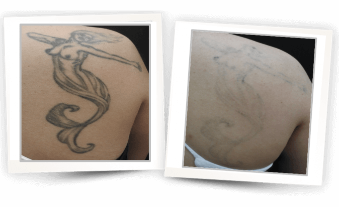 Medispa S10 Sheffield Nottingham Derby Chesterfield Skin Tattoo Removal 005