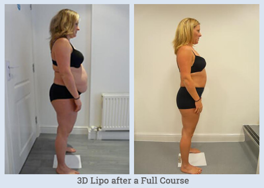 3D Lipo Lady Before and After Medispa S10 Sheffield Skin Tightening and Slimming Treatment