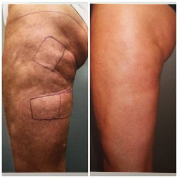 Mountain View Cellulaze Anticellulite Treatment Before and After Photos   Palo Alto Plastic Surgery Photo Gallery  Dr Robert Lowen24301  Lowen  Robert enhancedyoucom