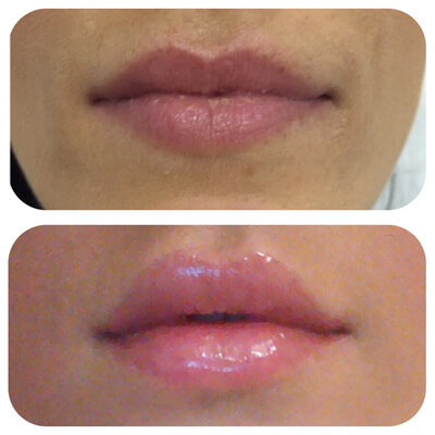 Medispa S10 Sheffield Clinic Aesthetics Dermal Fillers 007