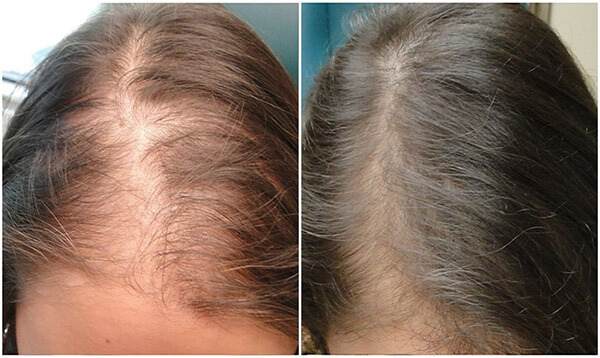 Medispa S10 Sheffield PRP Hair Loss Treatment Picture 001