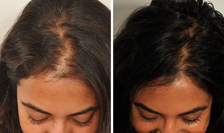PRP Hair Loss Treatment Sheffield | Medispa S10 Clinic