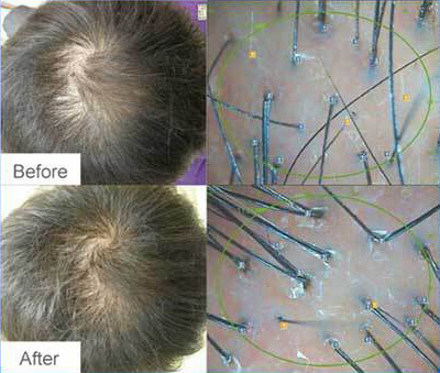 Medispa S10 Sheffield PRP Hair Loss Treatment Picture 006