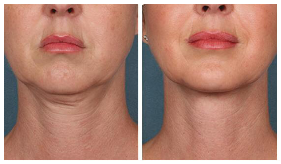 Medispa S10 Sheffield PRP Stem Cell Therapy Treatment 002