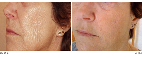 Medispa S10 Sheffield PRP Stem Cell Therapy Treatment 004