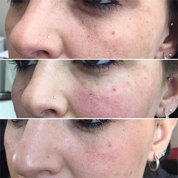 Medispa S10 Sheffield PRP Stem Cell Therapy Treatment 005