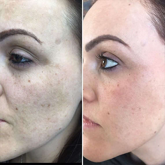 Medispa S10 Sheffield PRP Stem Cell Therapy Treatment 006