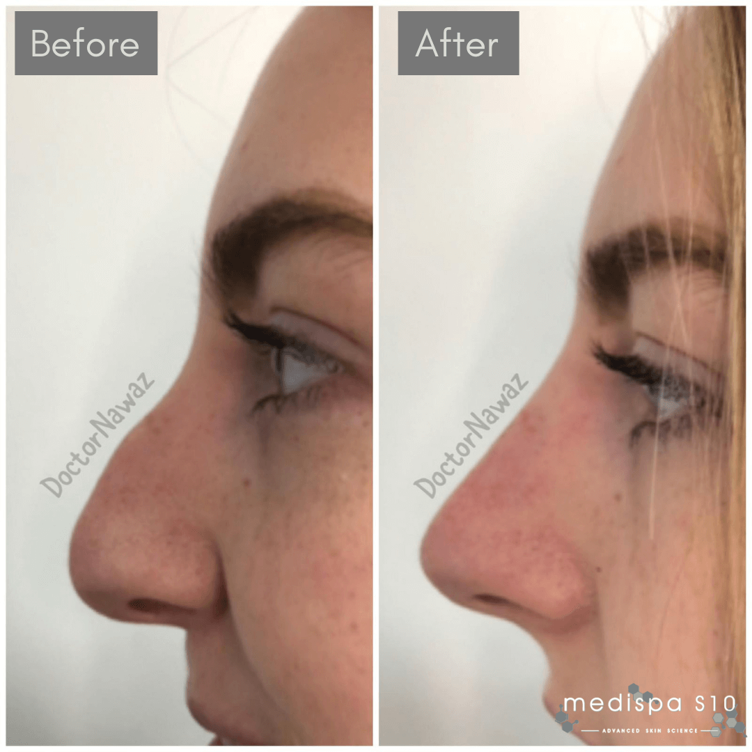 nose job sheffield